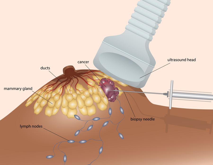 biopsy_diagram biopsy_diagram