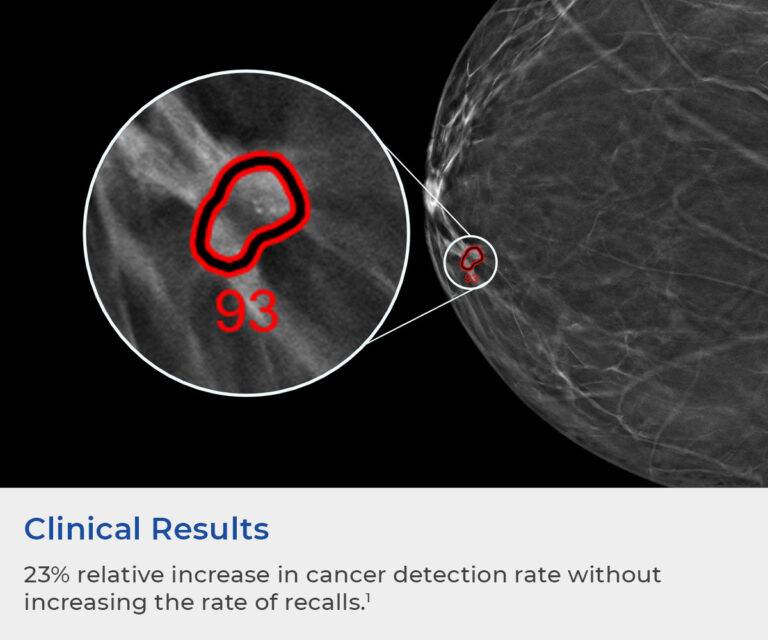 AI with mammography