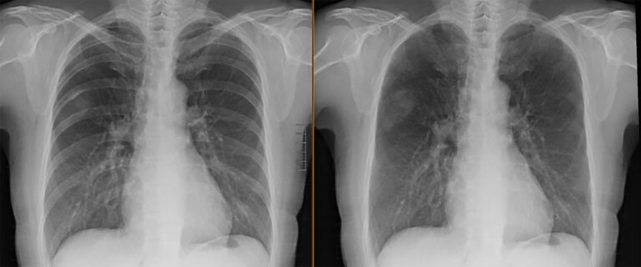 Bone suppression x-ray study