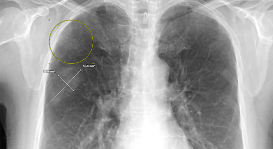 Bone suppression x-ray study