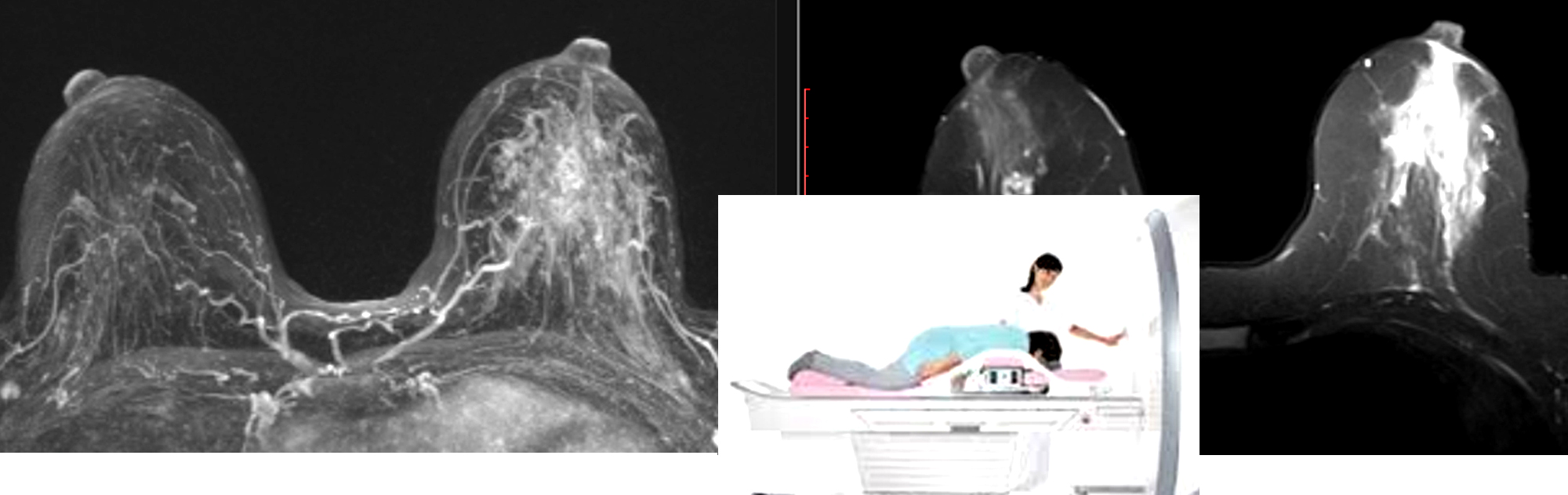 Breast MRI exam