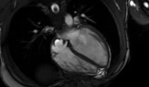 Cardiac MRI exam showing the beating heart