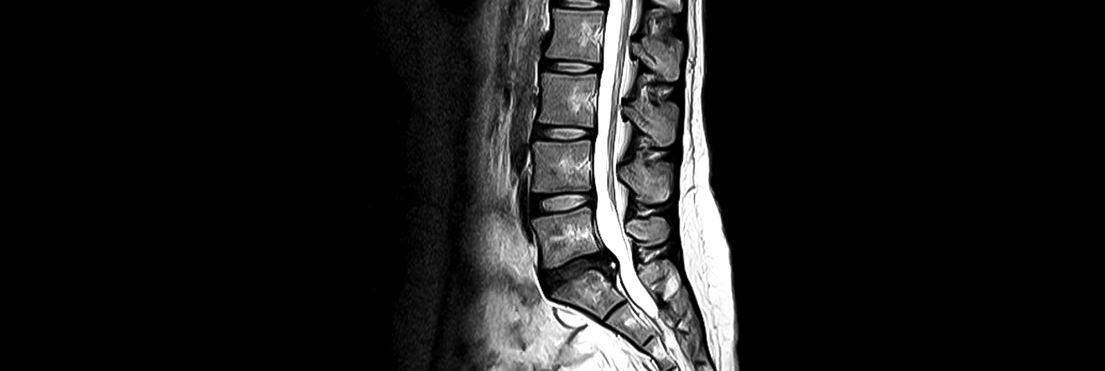 Lumbar spine MRI
