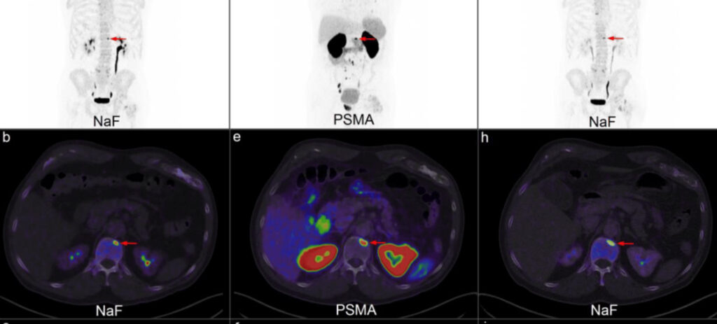 PSMA PET scan for prostate cancer