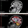 NeuroQuant MRI for neurodegenerative diseases