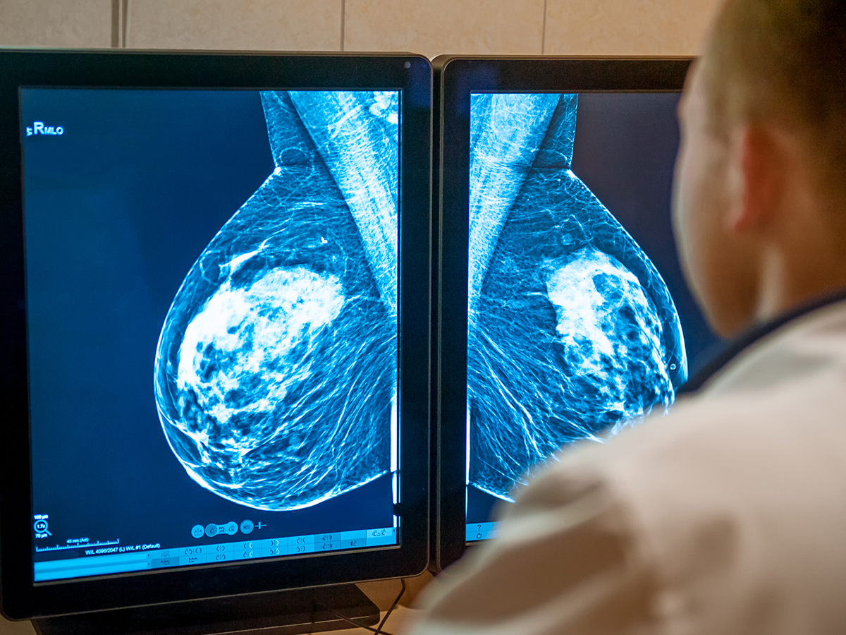 doctor looking at breast x-rays